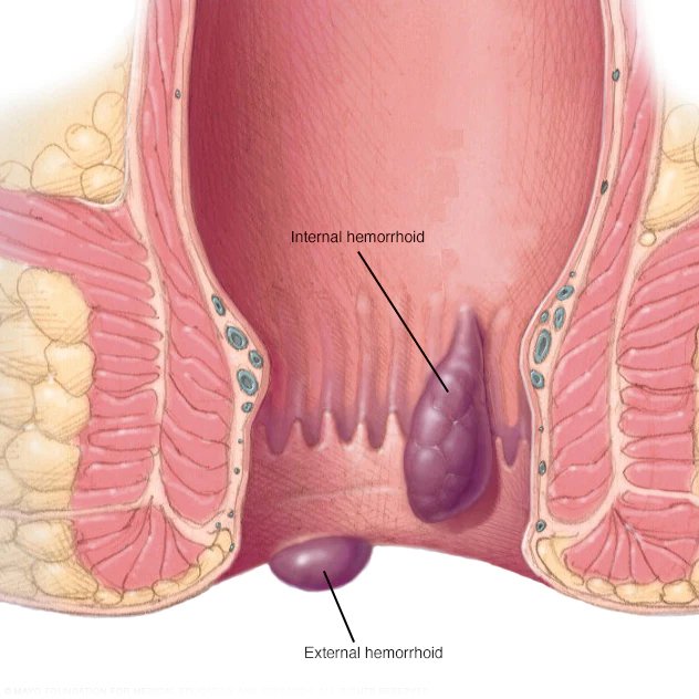 Hemorrhoids Laser Surgery in Jalandhar