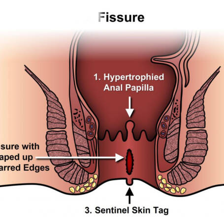 fissure fissure